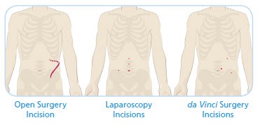 Pyeloplasty Incisions